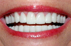 Porcelain Crowns