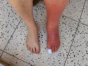 Understanding the Cause, Symptoms and Cure on Cellulitis Understanding the Cause, Symptoms and Cure on Cellulitis