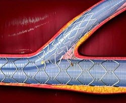 Cappella – Sideguard Coronary Sidebranch Stent Cappella – Sideguard Coronary Sidebranch Stent