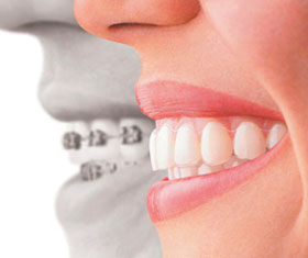 invisalign
