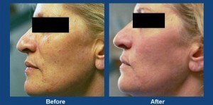 IPL Skin Rejuvenation IPL Skin Rejuvenation