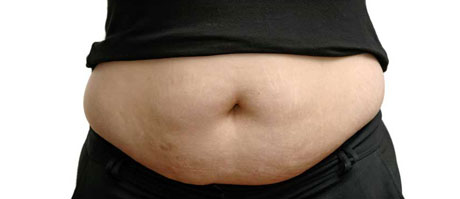 liposuction-for-weight-loss