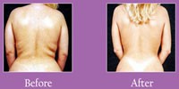 The ultimate liposuction procedure: Vaser The ultimate liposuction procedure: Vaser