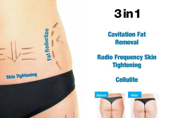 3d lipo