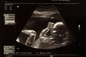 Growth scan of baby in mothers womb