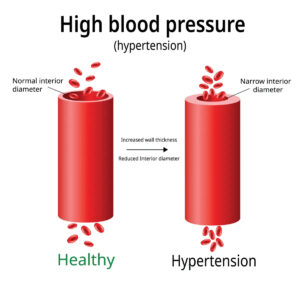 How To Manage High Blood Pressure