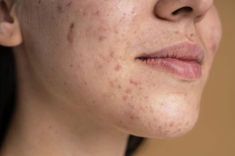 New ‘Harmless’ Skin Virus May Combat Acne