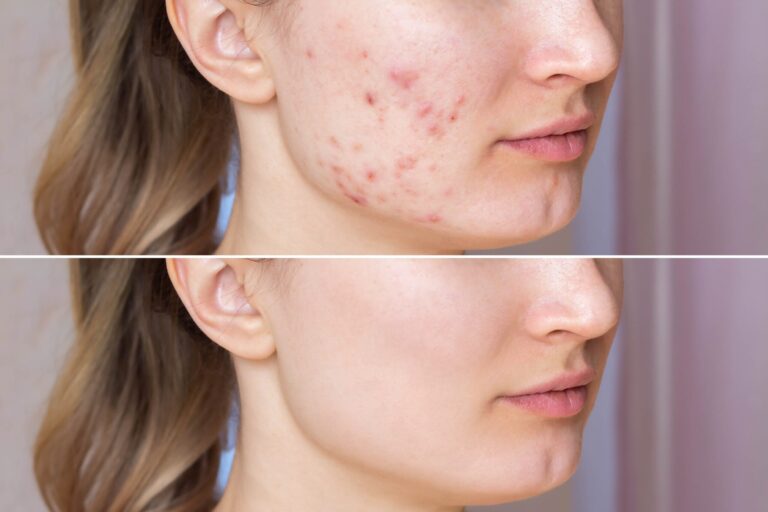 Laser Treatment For Acne