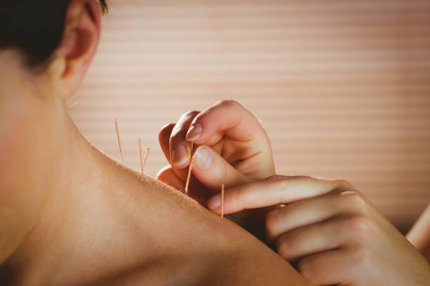 How Acupuncture Can Help You Heal