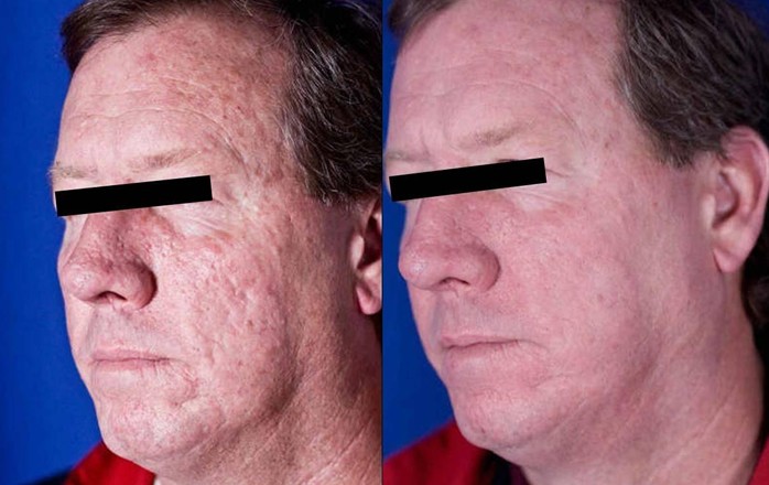 Laser treatment for acne