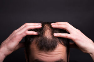 Man touching bald patches in hair