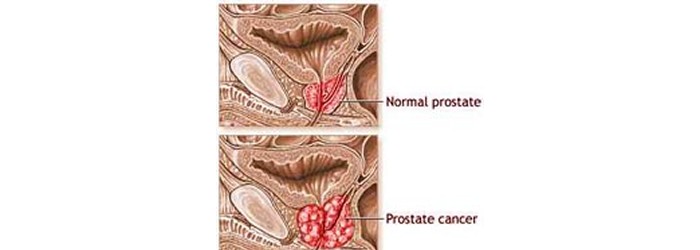 Efficient prevention of prostate cancer