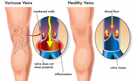 varicose-veins